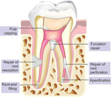Maarc MTA Repair Material / Root and Vital Pulp Therapy