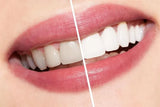 Ammdent Ultra White Professional Bleaching Kit - Tooth Whitening Gel