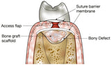 Advance Biotech Osseograft DMBM Bone Graft / De-Mineralized Bone Collagen