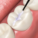 Sealant Pit & Fissure 