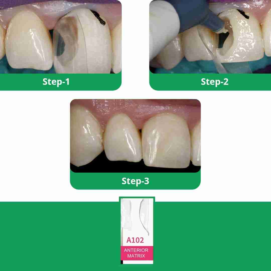 Dental Avenue Bioclear Anterior Matrix Kit - Esthetic Restorations Sys ...