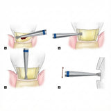 Mani Diamond Burs - SI Series