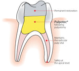 Pulp Devitalization Dental Filling Material