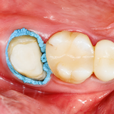 3M Astringent Retraction Paste Capsules 