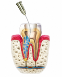 Neoendo Neoedta Gel (17% EDTA Gel) Root Canal Preparation Material