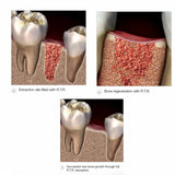 Septodont R.T.R Syringe Dental Bone Graft Material