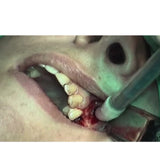 Geistlich Bio-Oss Pen / Ready-to-Use Bone Regeneration Material