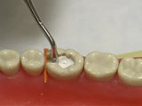 Ammdent Zino-Gen Temporary Restorative Material / ZOE Dental Cement