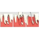 Luxatip Dual Edge 3mm DE3 