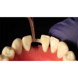 Ammdent Infibra Fiber Splint Reinforcement Ribbion & Orthodontic Retention