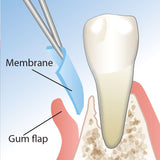 Advance Biotech Healiguide Membrane / Dental Bone Graft Collagen