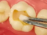 Ammdent D-Pulp Devitalizing Dental Paste / For Root Canal Treatments
