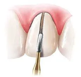 Prima Dental Predator Turbo Bur Air Rotor-FG (For Crown Cutting)