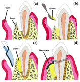 Advance Biotech Healiguide Membrane / Dental Bone Graft Collagen