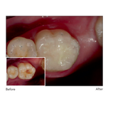 GC Gold Label Hybrid Self-Adhesive Posterior Restorative