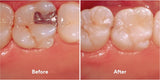 Dental Composite Restorative Material