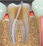 PD Swiss EndoFill Dental Root Filling Material - (Powder+Liquid)